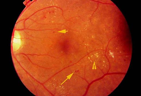 ангиопатия на ретината 